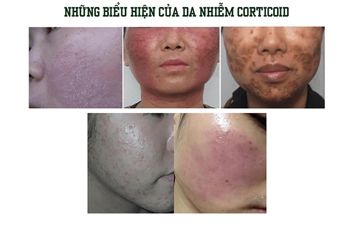 Những biểu hiện da nhiễm Corticoid1.jpg